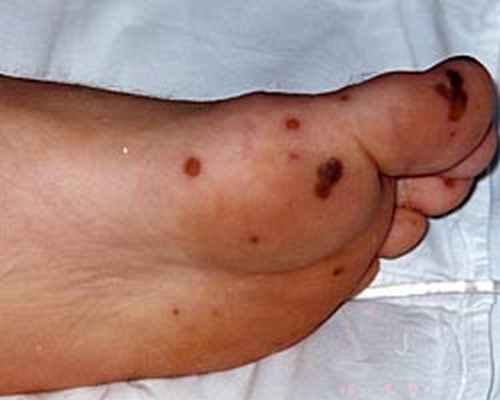 На коже правой стопы высыпания по типу геморрагических некрозов кожи