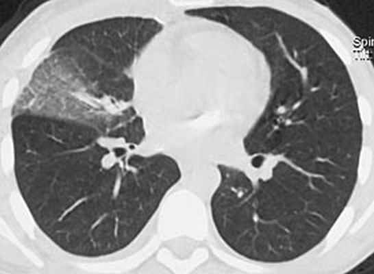 компьютерная томография органов грудной клетки