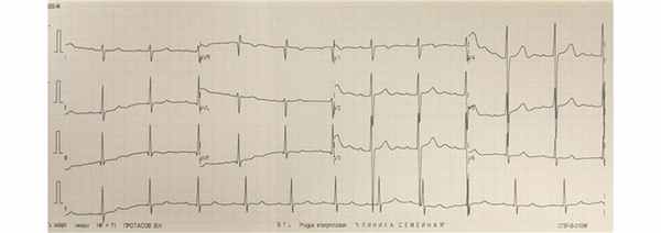 ДвуфазныйзубецТ, выраженные волны U в отведених V2-V4.