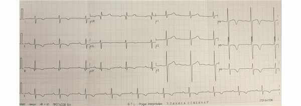 Ритм синусовый, правильный. Частота сердечных сокращений 61 в минуту. Отклонение ЭОС вправо.