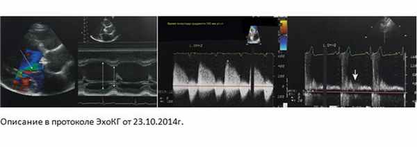 Тактика ведения больных с аортальной недостаточностью.
