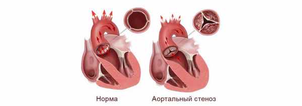 Ведение больных с двустворчатым аортальным клапаном (амбулаторно)