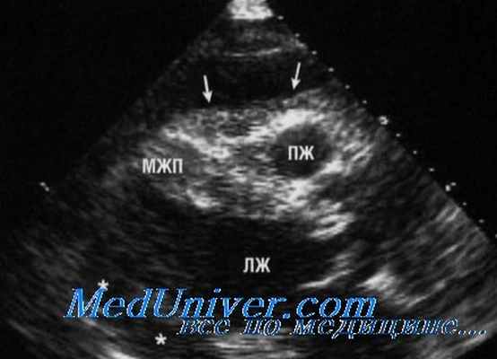 перикардиальный выпот