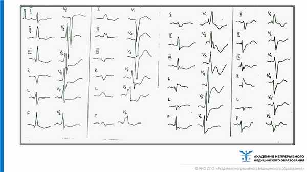 блокада ножек пучка Гиса