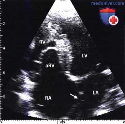 ЭхоКГ при врожденной аномалии Эбштейна