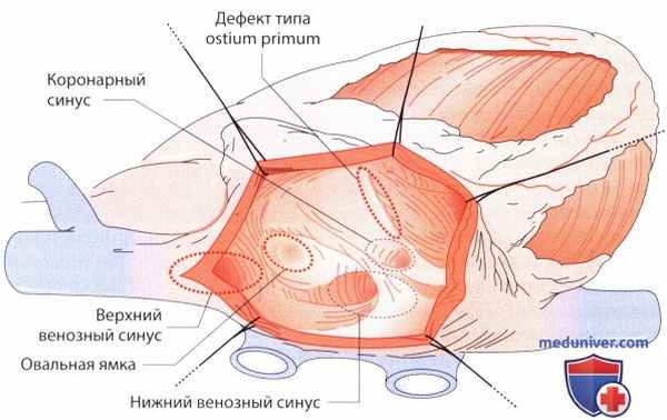 ЭхоКГ при врожденном дефекте межпредсердной перегородки (ДМПП)