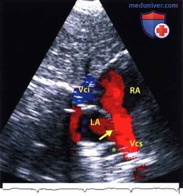ЭхоКГ при врожденном дефекте межпредсердной перегородки (ДМПП)
