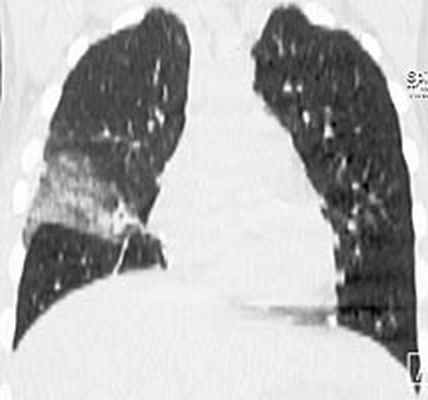 компьютерная томография органов грудной клетки