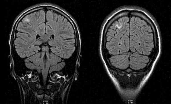 МРТ головного мозга 