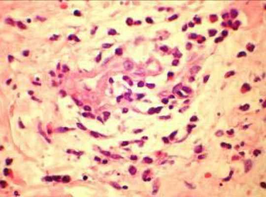 биопсия кожно-мышечного лоскута