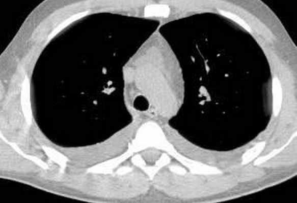 КТ органов грудной клетки