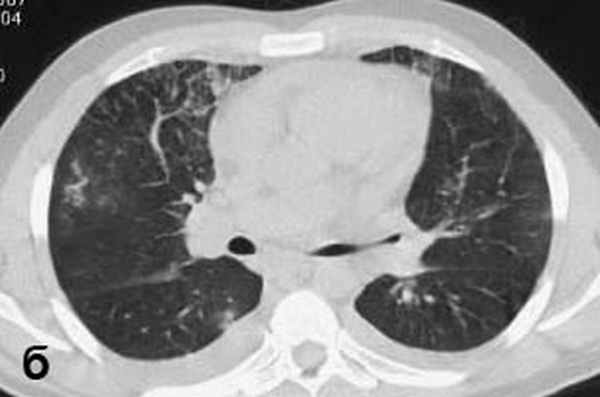 КТ грудной клетки