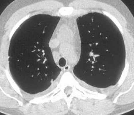 КТ грудной клетки