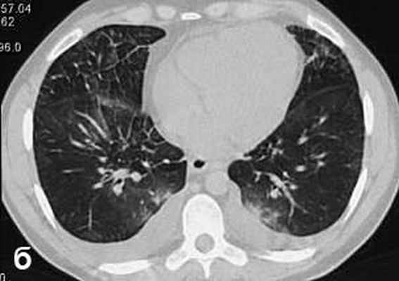 КТ грудной клетки