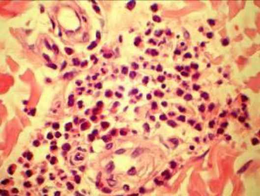 биопсия кожно-мышечного лоскута