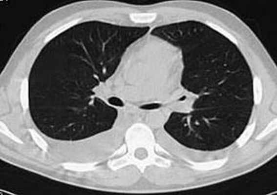 КТ органов грудной клетки