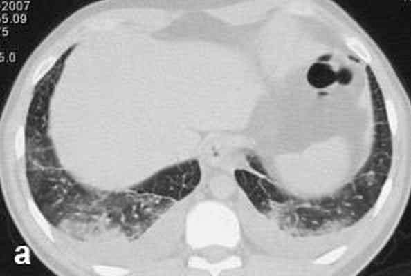 КТ грудной клетки