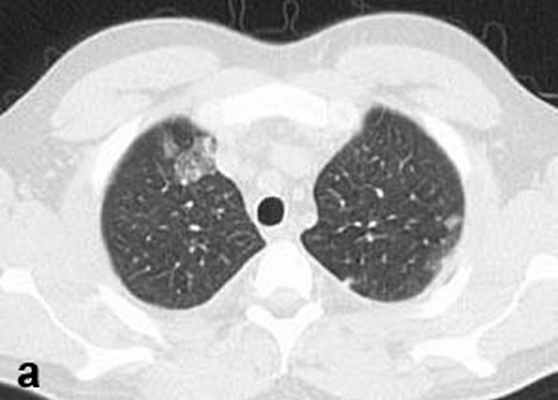 КТ грудной клетки