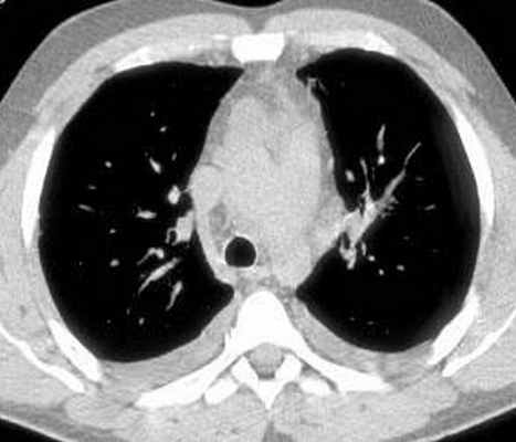 КТ грудной клетки