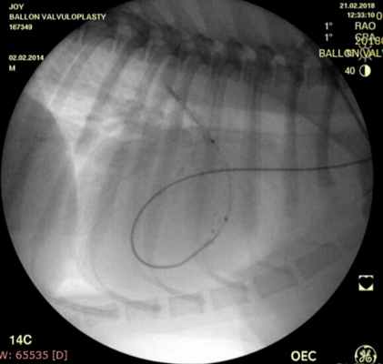 Рис.2 Баллонопластика.jpg