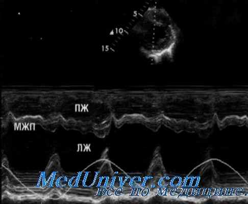 ЭхоКГ при констриктивном перикардите