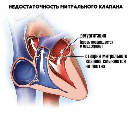 Митральная недостаточность 2.jpg