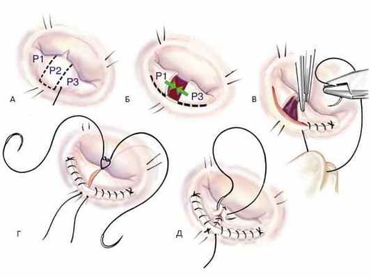 Лечение митральной недостаточности (3).jpg