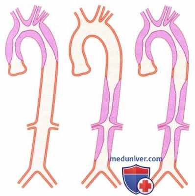 ЭхоКГ при расслоении стенки аорты (аневризме аорты)