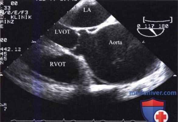 ЭхоКГ при расслоении стенки аорты (аневризме аорты)