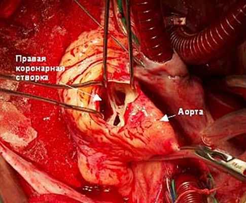 Интраоперационный вид субаортальной мембраны