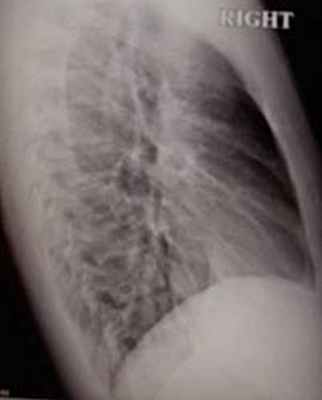 Рентгенограмма органов грудной клетки