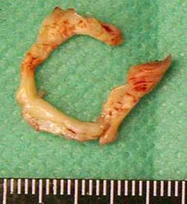 Препарат иссеченной субаортальной мембраны.