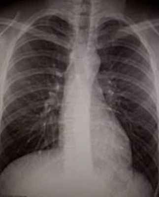 Рентгенограмма органов грудной клетки