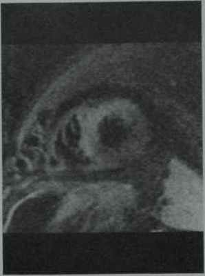 Снимки МРТ и КТ. Трансплантация сердца