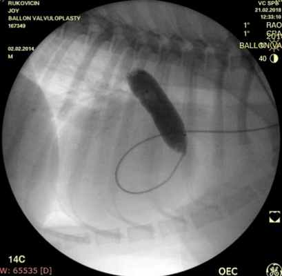 Рис. 4 Баллонопластика.jpg