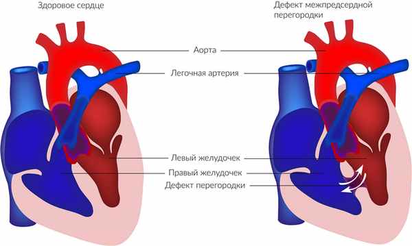 Дефект межпредсердной перегородки.jpg