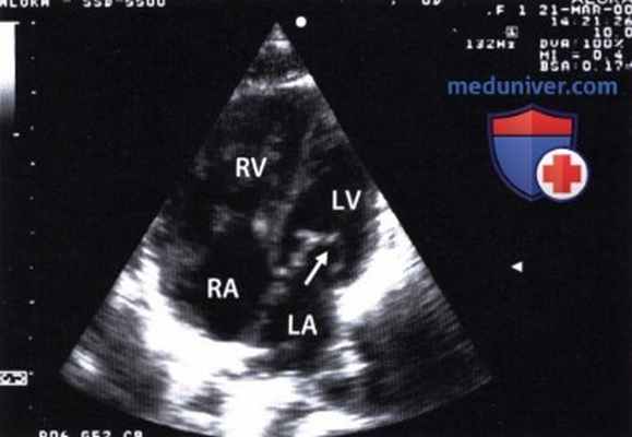 ЭхоКГ при врожденном митральном стенозе