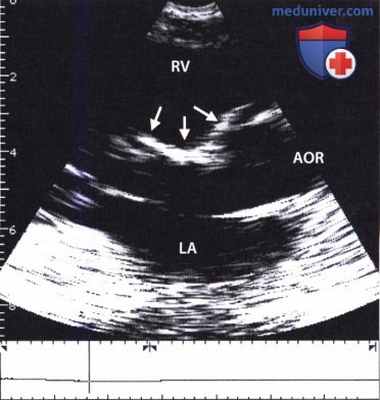 ЭхоКГ при врожденном дефекте межжелудочковой перегородки (ДМЖП)