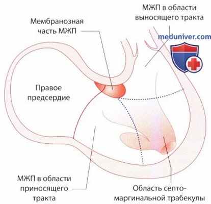 ЭхоКГ при врожденном дефекте межжелудочковой перегородки (ДМЖП)