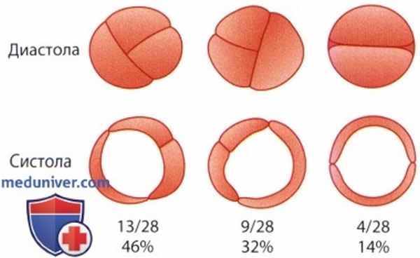 ЭхоКГ при врожденном стенозе аортального клапана (двустворчатом аортальном клапане)