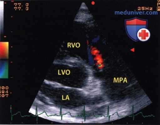 ЭхоКГ при врожденном стенозе клапана легочной артерии