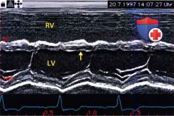 ЭхоКГ при врожденной недостаточности клапана легочной артерии