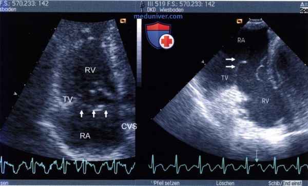 ЭхоКГ трикуспидального (трехстворчатого) клапана сердца