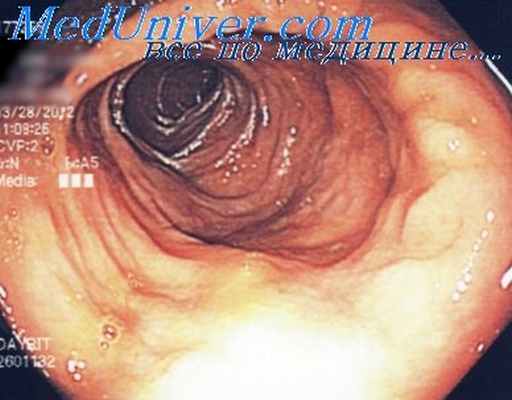 еюноскопия