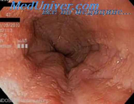 эзофагоскопия