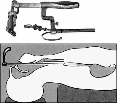 Что такое эзофагоскоп