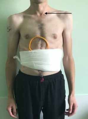 Удаление свища пищевода