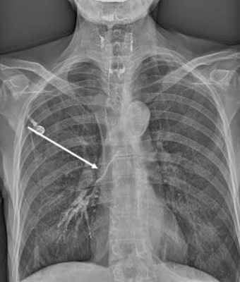 Свищ пищевода на рентгене