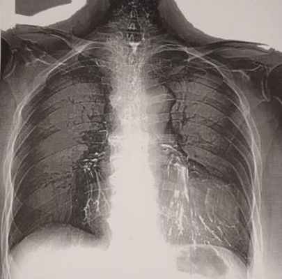 Остатки бария сульфата в бронхах у пациентки с пищеводно-бронхиальными свищами