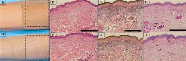 Клинические и гистологические эффекты процедуры BBL